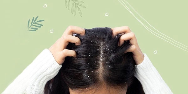بهترین شامپوهای ضد شوره برای موهای چرب