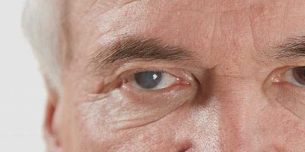 همه چیز درباره آب مروارید