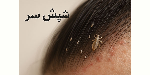 شپش سر